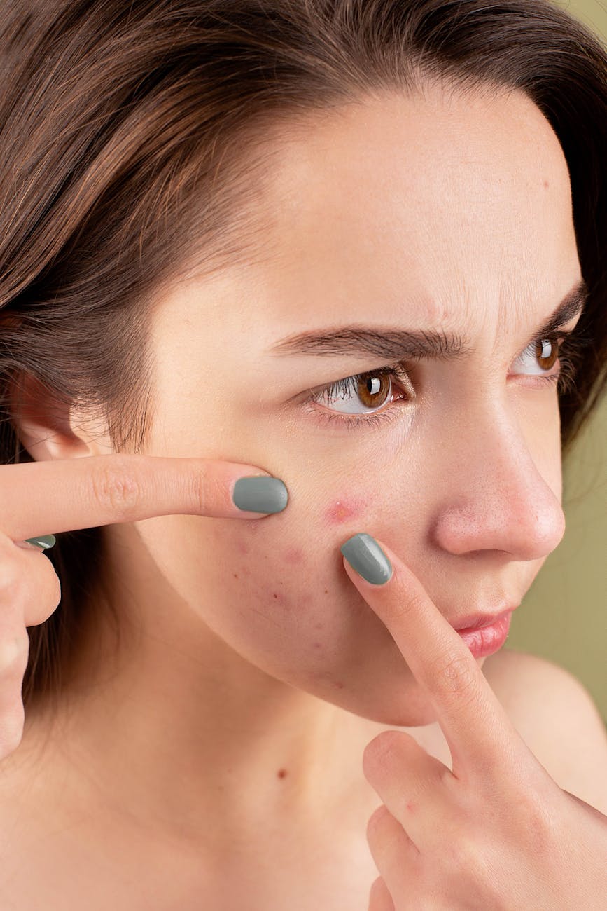 acne prone skin
