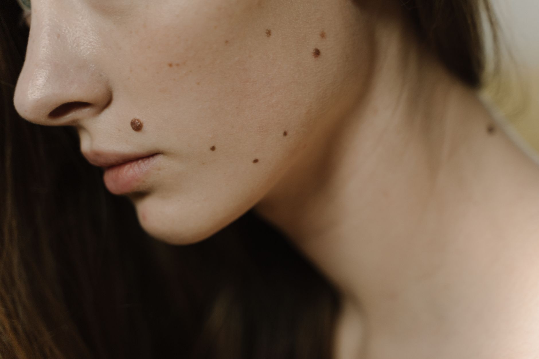 skin with moles